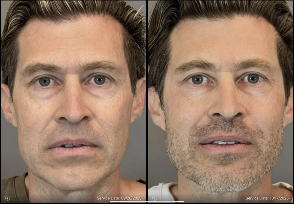 Nouvaderm - Before and After treatment Image