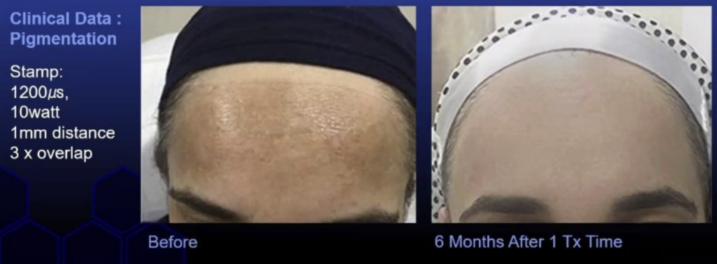 Nouvaderm - Clinical Data - Pigmentation - Rejuvayou
