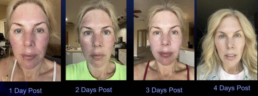 Nouvaderm - Progress by day Image