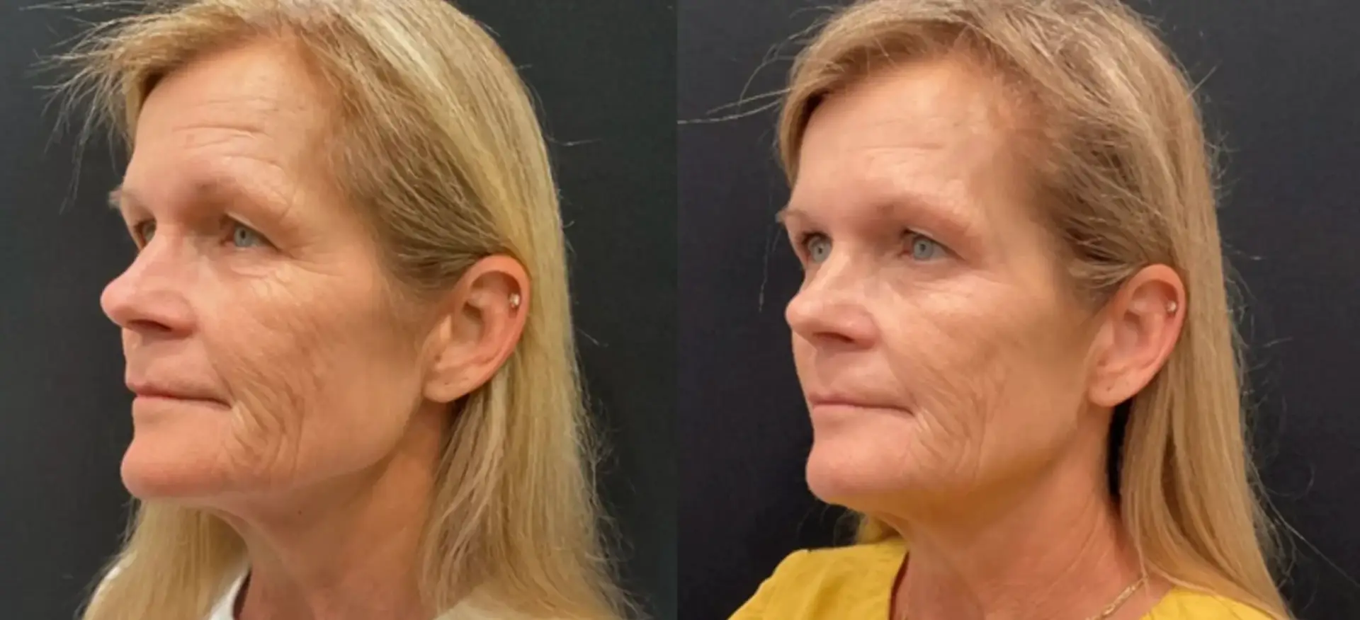 Sofwave before and after — skin tone and texture result