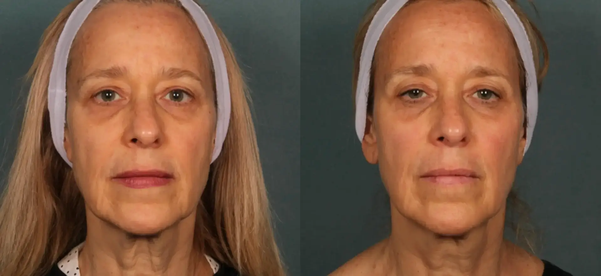Sofwave before and after — skin firmness result