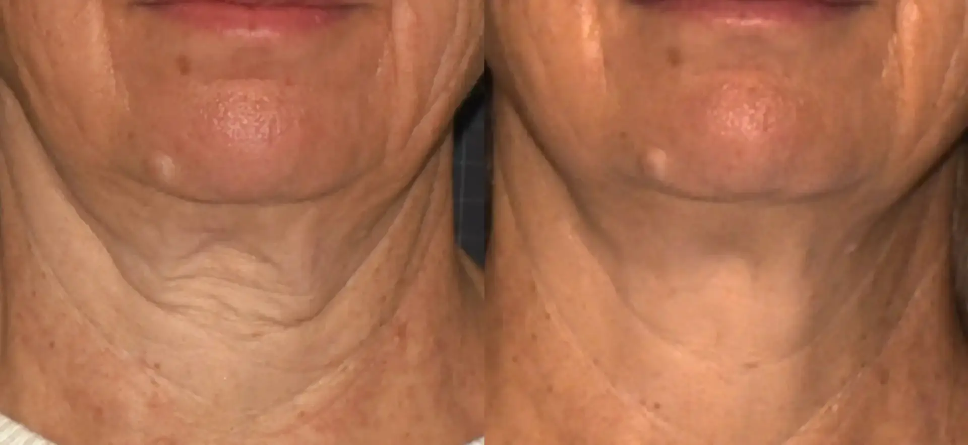 Sofwave before and after — jawline and neck lifting result