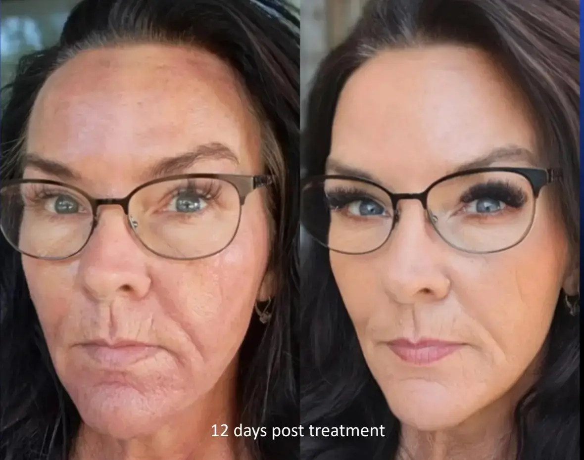 Lift & Glow before and after result 1