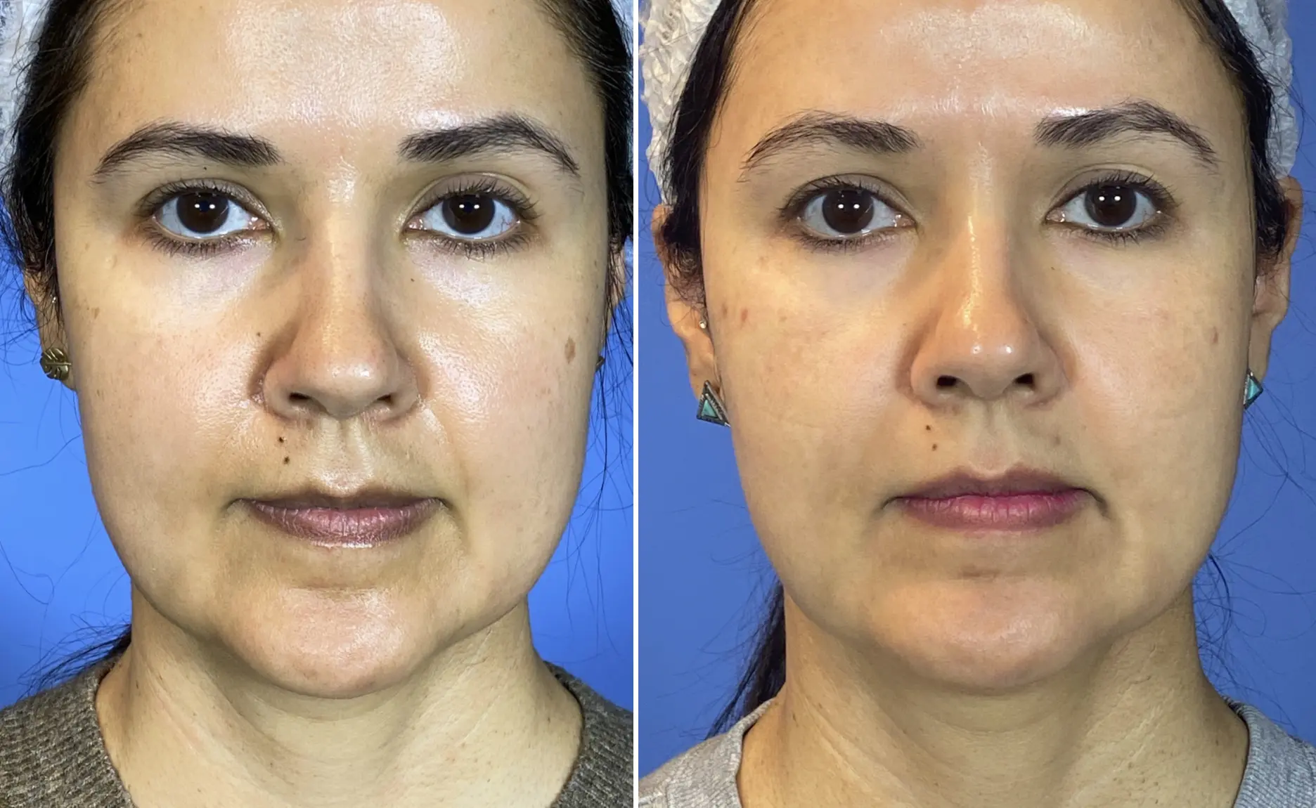 Lift & Glow before and after result 2