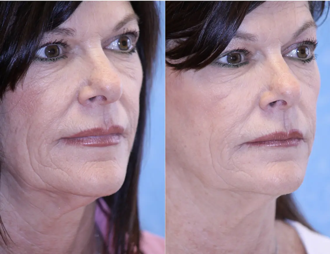 Lift & Glow before and after result 3